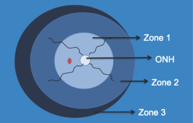 Diagram of the retina divided into three zones used to classify the location of retinopathy of prematurity