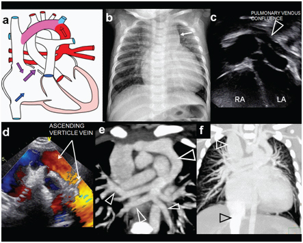 Total anomalous pulmonary venous return imaging showing anomalous drainage of pulmonary veins via vertical vein to systemic venous system