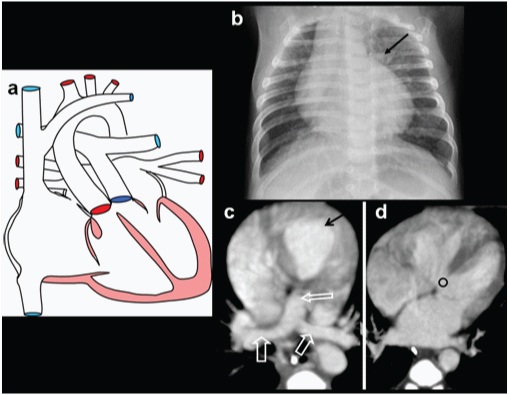 Transposition of the great arteries imaging showing diagrammatic illustration with anteriorly positioned aorta and posteriorly positioned pulmonary artery