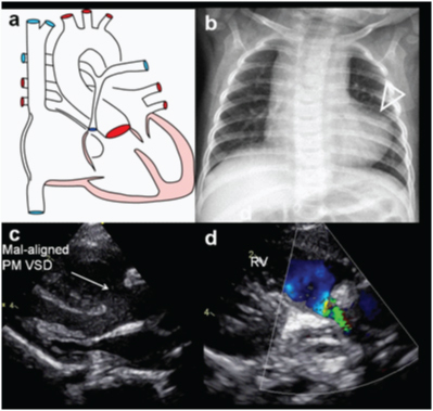 Tetralogy of Fallot anatomy and imaging including diagrammatic representation, chest radiograph with boot-shaped heart, echocardiography showing VSD and RVOT obstruction