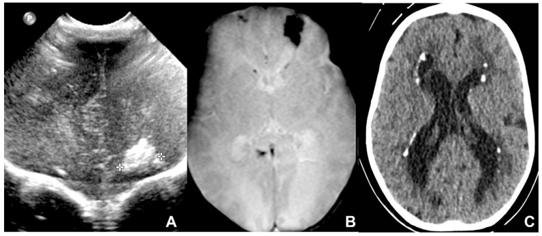 Cranial ultrasound and neuroimaging of congenital CMV infection showing periventricular calcifications and frontal lobe changes