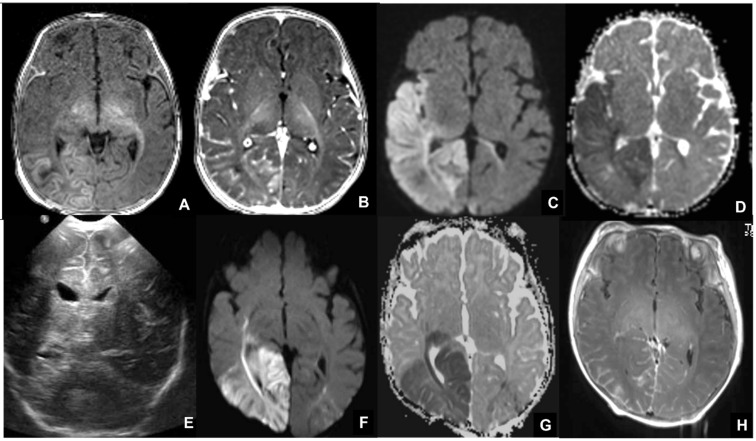 Brain MRI in neonatal herpes simplex virus infection showing cortical-subcortical signal changes and diffusion restriction