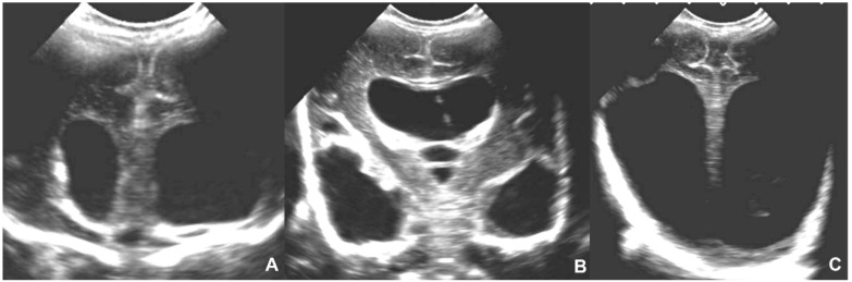 Cranial ultrasound in congenital toxoplasmosis showing massive ventricular dilatation and scattered intracranial calcifications