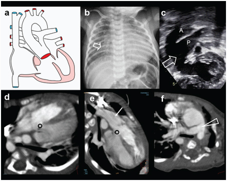 Truncus arteriosus imaging showing a single arterial trunk arising from both ventricles overriding a large VSD with pulmonary arteries branching from the common trunk