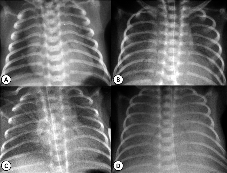 Chest radiograph grading of neonatal respiratory distress syndrome showing progressive opacification from grade 1 through grade 4