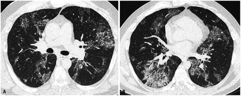 CT scan showing diffuse alveolar filling pattern in acute silicoproteinosis