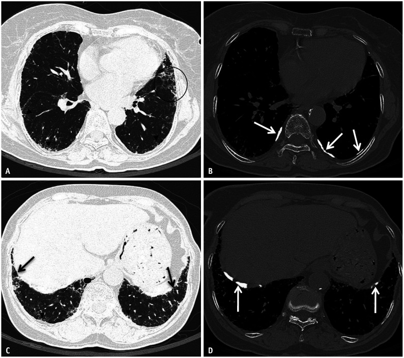 CT scan showing asbestosis with lower lobe fibrosis and subpleural honeycombing