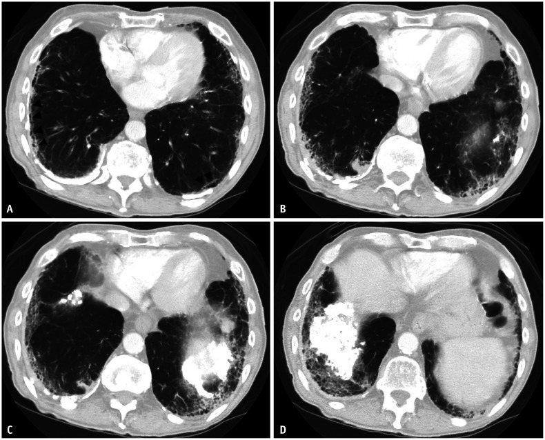 HRCT showing advanced asbestosis with honeycombing pattern in the lower lobes