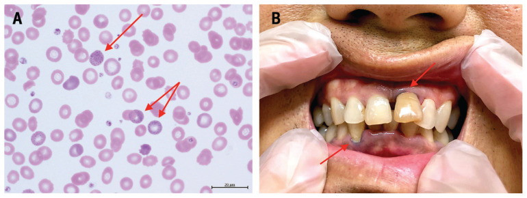 Clinical photographs showing Burton line on gingiva and basophilic stippling on blood smear in lead poisoning