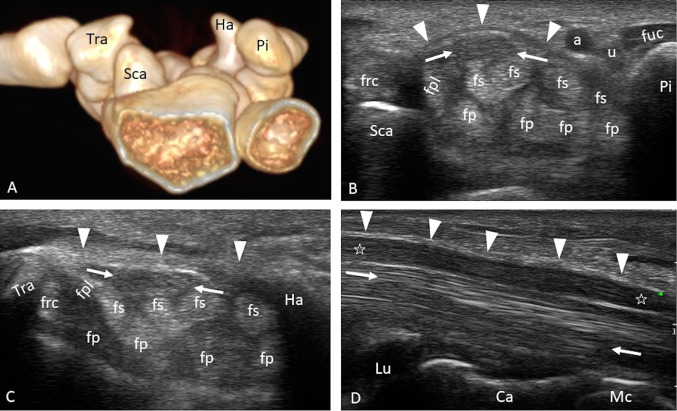 Ultrasound image showing normal carpal tunnel anatomy with median nerve and flexor tendons