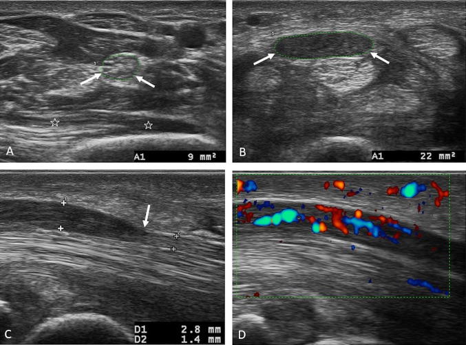 Ultrasound showing morphological changes of median nerve in carpal tunnel syndrome