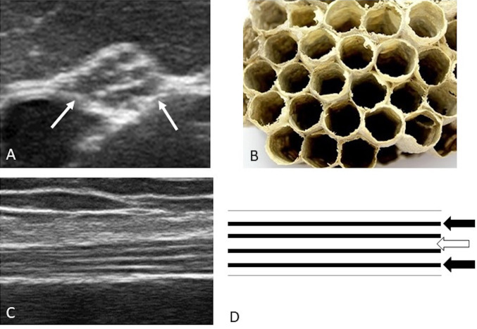 Ultrasound image showing median nerve morphology in the carpal tunnel