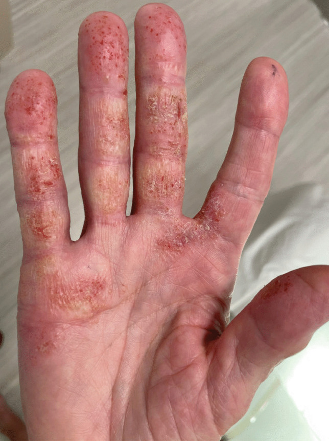 Clinical photograph showing allergic contact dermatitis on the hand
