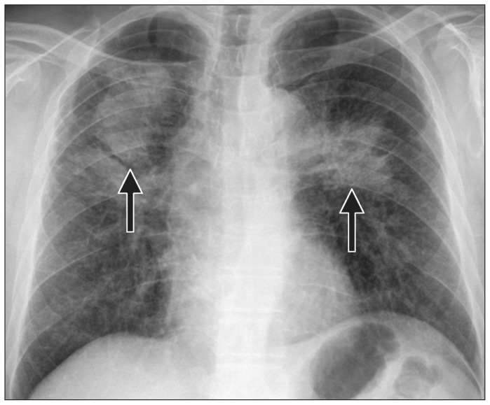 Chest radiograph showing coal workers pneumoconiosis with progressive massive fibrosis
