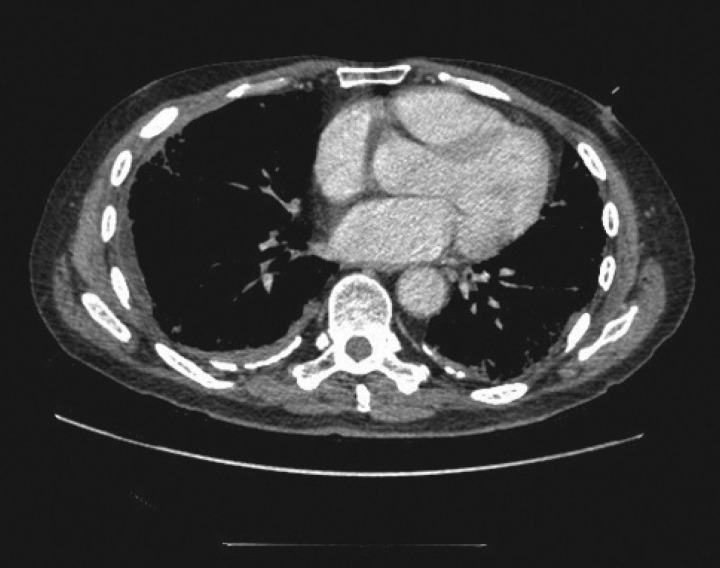 CT showing diffuse pleural thickening from asbestos exposure