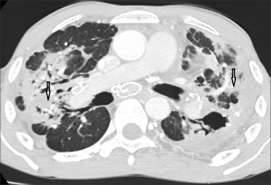 HRCT lung window showing silicotic nodules with upper lobe predominance