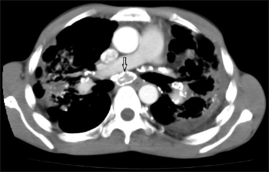 HRCT mediastinal window showing eggshell calcification of lymph nodes