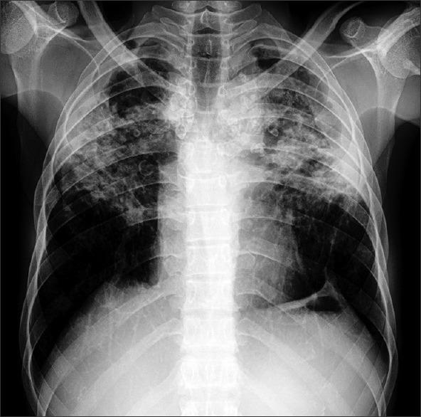 Chest radiograph showing eggshell calcification of lymph nodes in silicosis
