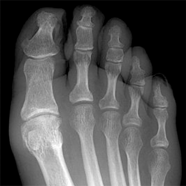 Clinical photograph showing frostbite with tissue discoloration and blister formation