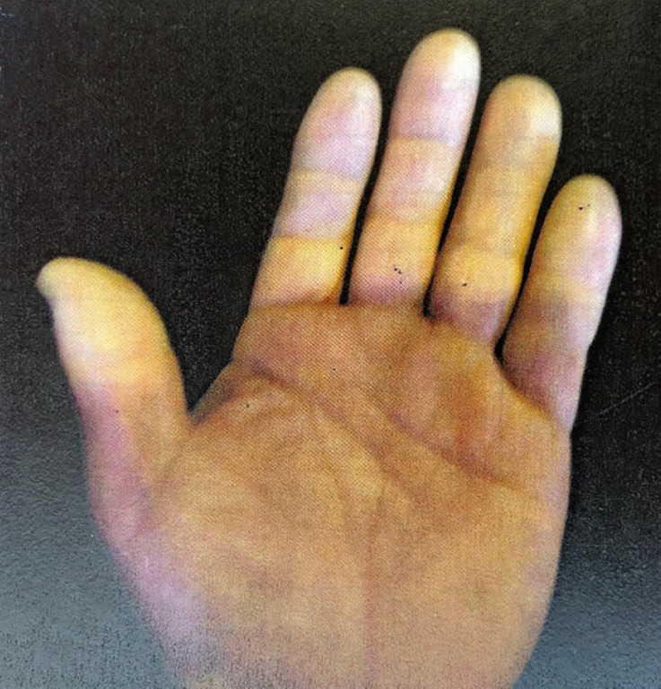 Photograph of Raynaud phenomenon during cold provocation testing showing digital blanching