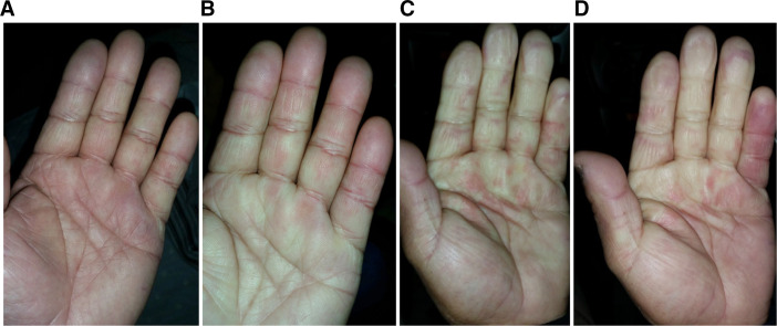 Clinical photographs showing Raynaud phenomenon recovery phases in HAVS patient