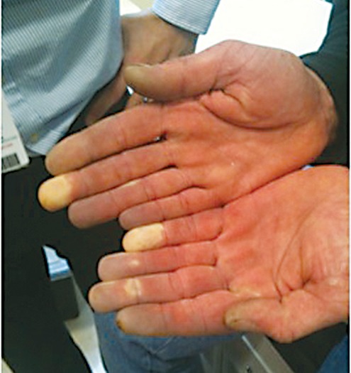 Clinical photograph showing digital blanching (vibration white finger) in hand-arm vibration syndrome