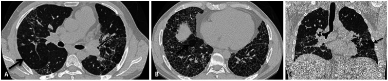 HRCT showing chronic fibrotic hypersensitivity pneumonitis with traction bronchiectasis