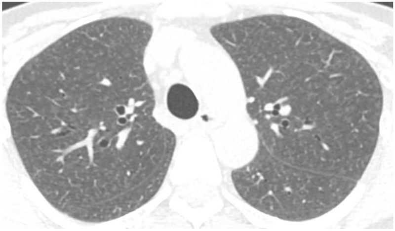 HRCT showing centrilobular ground-glass nodules in hypersensitivity pneumonitis