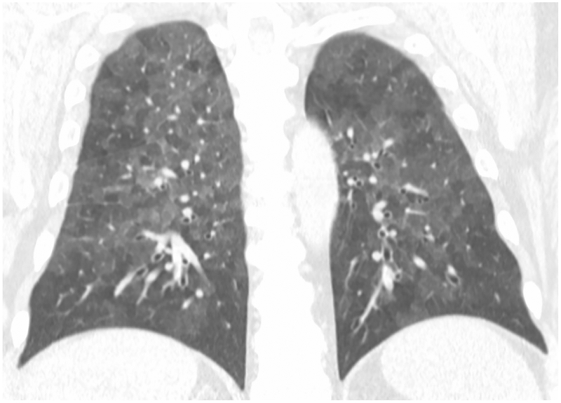 HRCT showing headcheese sign with mosaic attenuation in hypersensitivity pneumonitis