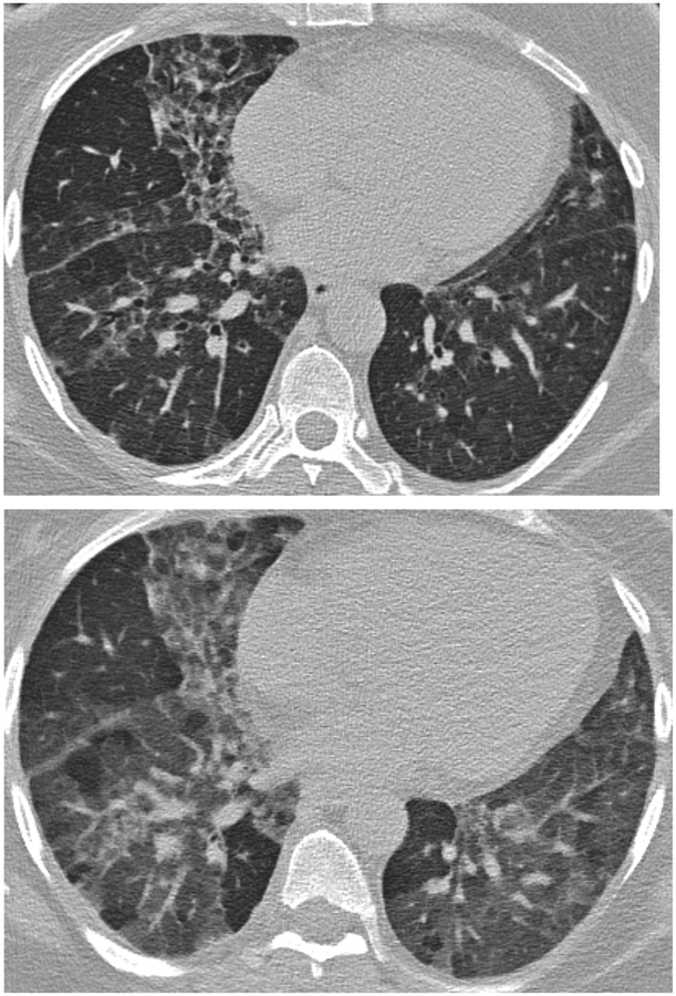 HRCT showing mosaic attenuation pattern in hypersensitivity pneumonitis