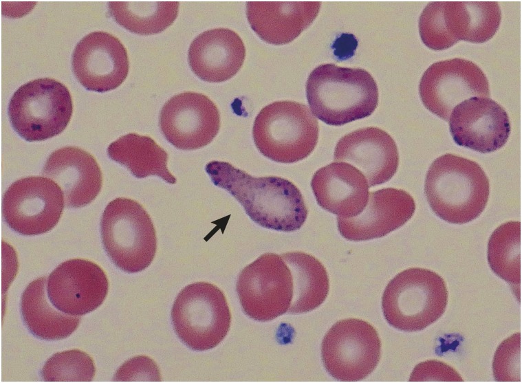 Peripheral blood smear showing basophilic stippling and teardrop cells in severe lead poisoning
