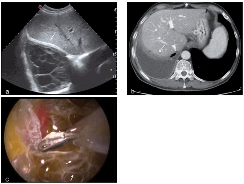 CT scan showing mesothelioma with diaphragmatic pleural thickening and effusion