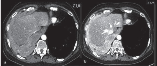 CT scan comparing arterial and portal phase enhancement in mesothelioma