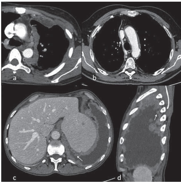 CT scan showing malignant pleural mesothelioma with circumferential pleural thickening