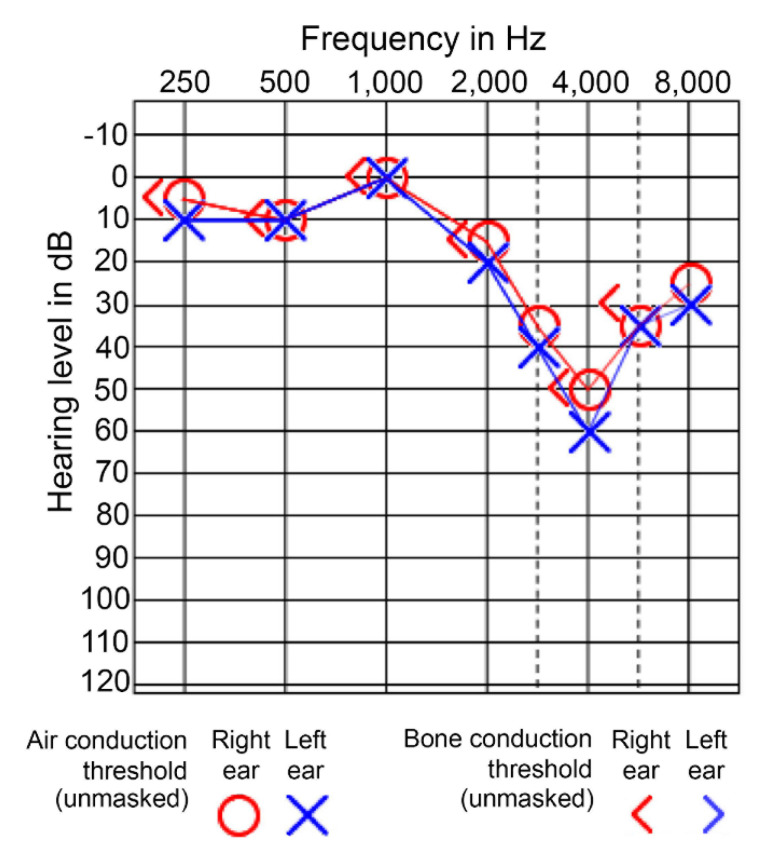 Audiogram showing characteristic 4000 Hz notch pattern in noise-induced hearing loss