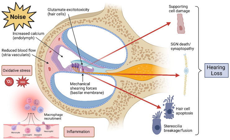 Diagram showing cellular mechanisms of noise-induced damage to cochlear hair cells
