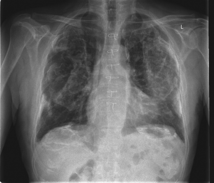 CT scan showing bilateral calcified pleural plaques in a patient with asbestos exposure