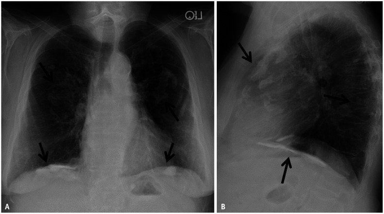 Chest radiograph showing bilateral pleural plaques from asbestos exposure