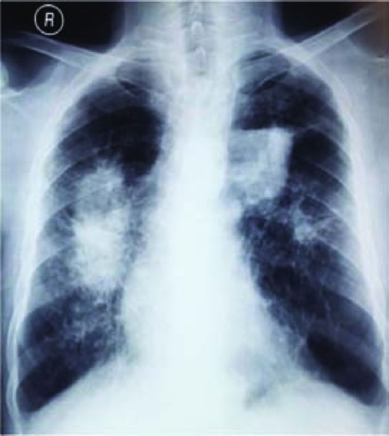Chest radiograph demonstrating progressive massive fibrosis with bilateral parahilar masses