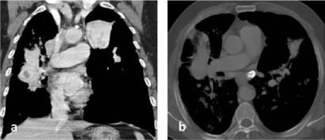 Axial CT scan showing progressive massive fibrosis with bilateral upper lobe masses