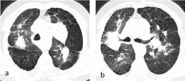 Coronal CT scan showing progressive massive fibrosis in silicosis