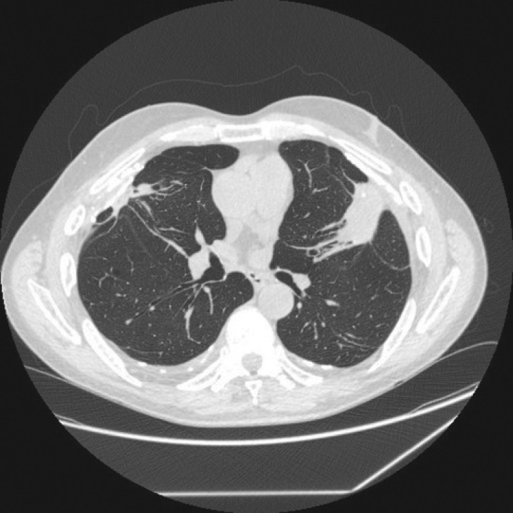 CT scan showing rounded atelectasis associated with asbestos-related pleural disease