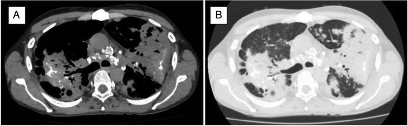 CT scan showing eggshell calcification of hilar lymph nodes in silicosis