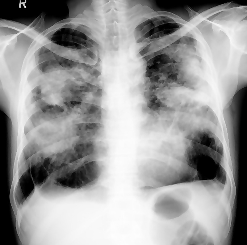 Chest radiograph showing silicosis with bilateral upper lobe masses in angel wings pattern