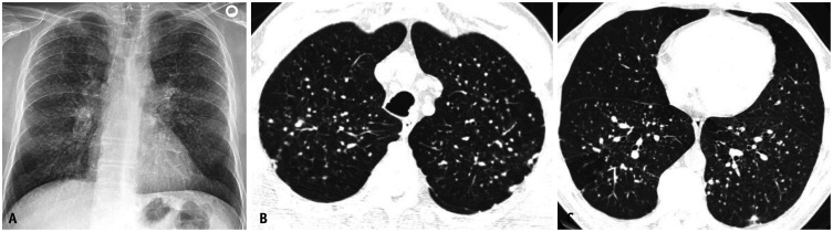 CT scan showing multiple small rounded silicotic nodules with upper lobe predominance