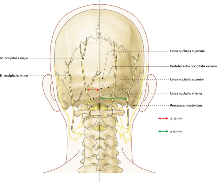 Occipital nerve anatomy showing greater and lesser occipital nerves at the nuchal line