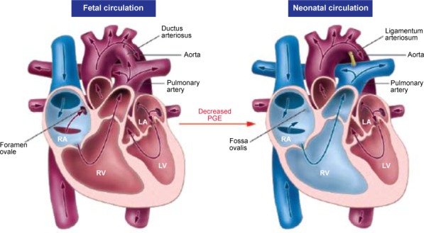 Diagram comparing fetal and neonatal ductus arteriosus function, showing the three fetal shunts and their postnatal closure