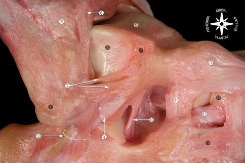 CFL and talocalcaneal relationship