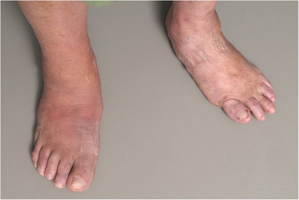 Acute Charcot foot showing erythema and swelling