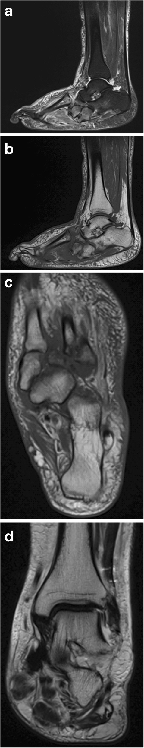 Midfoot beaming reconstruction for Charcot deformity